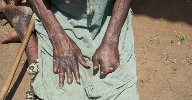 Leprakranke mit Behinderungen und Amputationen haben es im Südsudan besonders schwer. Teilweise sind die Beeinträchtigungen schon angeboren. © Enric Boixadós Leprakranke mit Behinderungen und Amputationen haben es im Südsudan besonders schwer. Teilweise sind die Beeinträchtigungen schon angeboren. © Enric Boixadós
