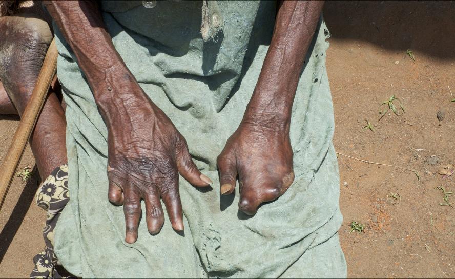 Leprakranke mit Behinderungen und Amputationen haben es im Südsudan besonders schwer. Teilweise sind die Beeinträchtigungen schon angeboren. © Enric Boixadós